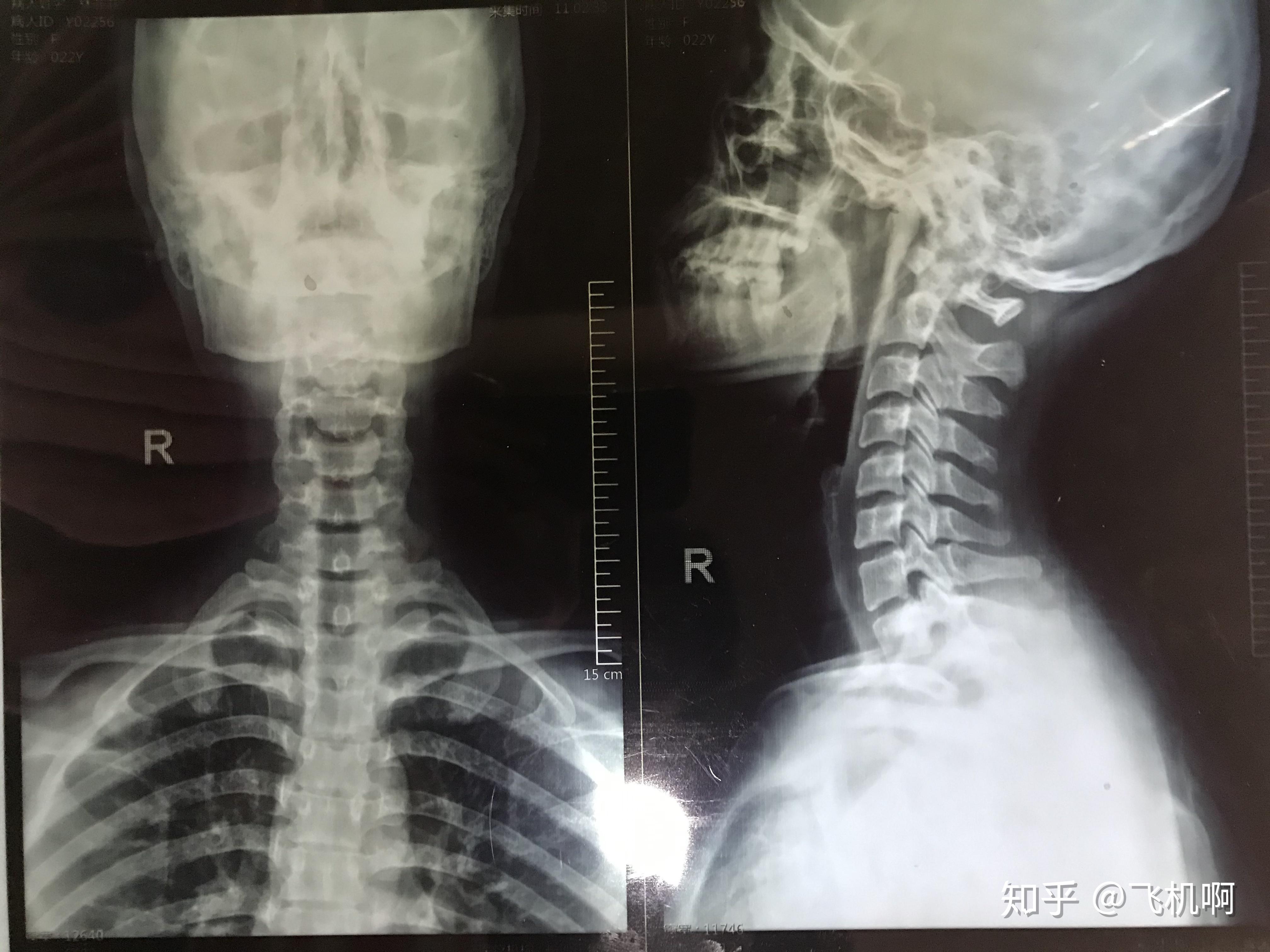 正常颈椎x光 x光片图片