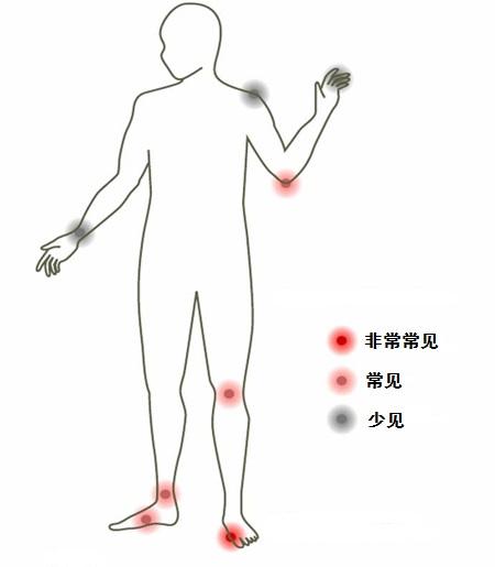 【痛风】答疑解惑 q&a (2)