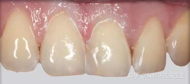 门牙蛀牙能补吗? - 知乎