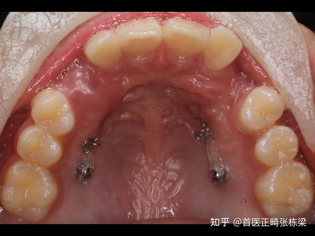 4,牙囊組織含有造成牙根和骨組織吸收的破骨細胞成分及活躍的破牙骨質