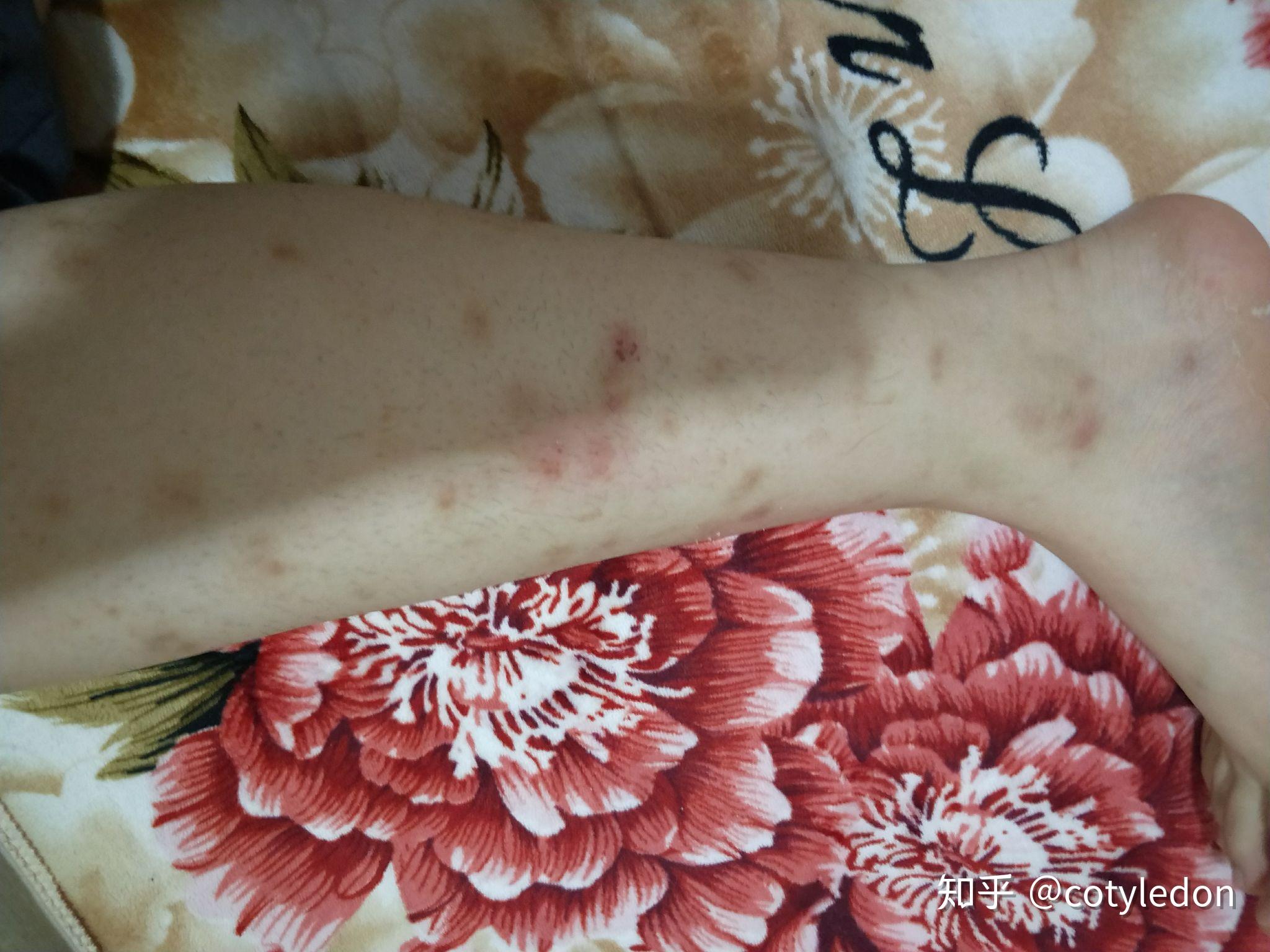 被跳蚤咬的全身都是包是什么样的感受! - 知乎