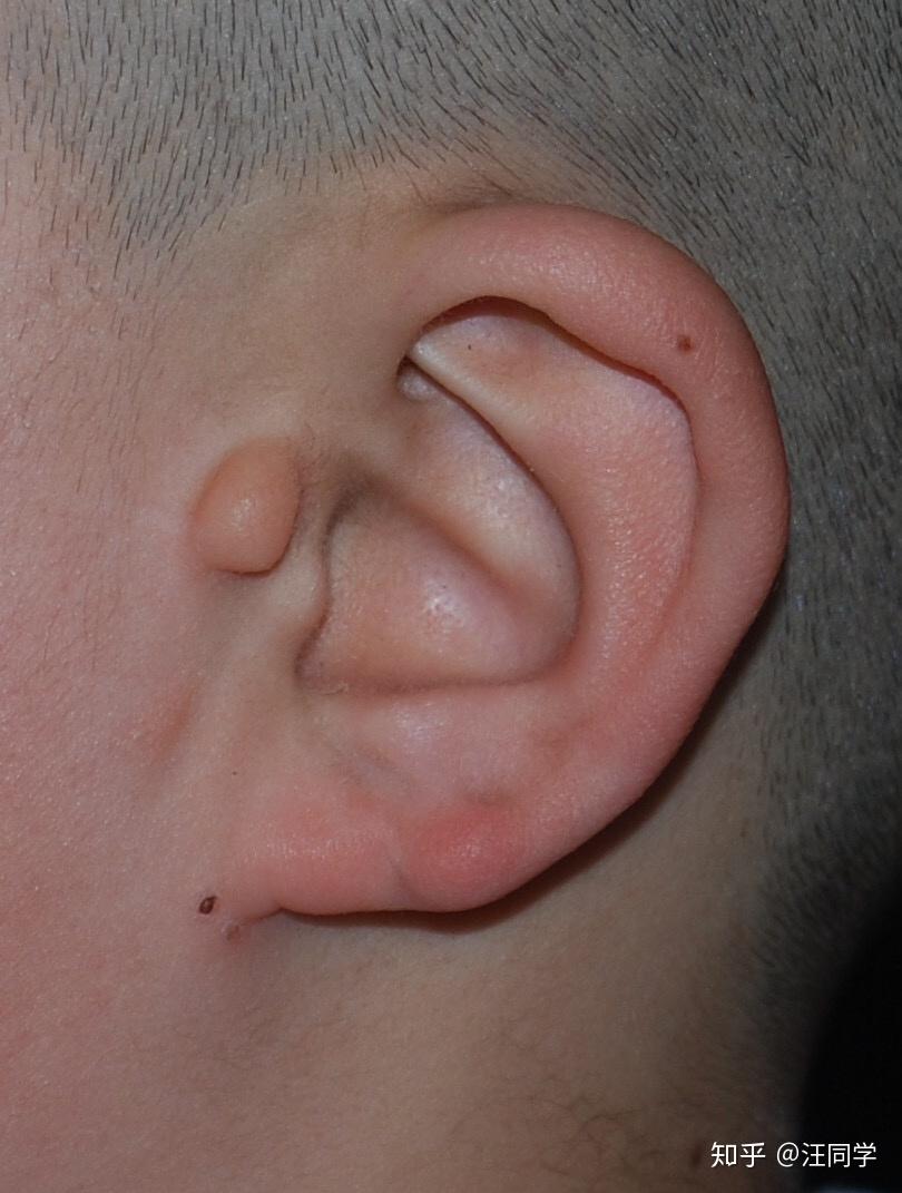 角膜皮样瘤 附耳图片