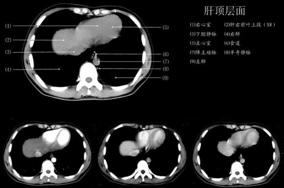 一图教你读懂 腹部CT - 知乎