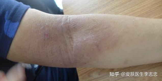 什么是特应性皮炎?中医如何治疗特应性皮炎? - 知乎