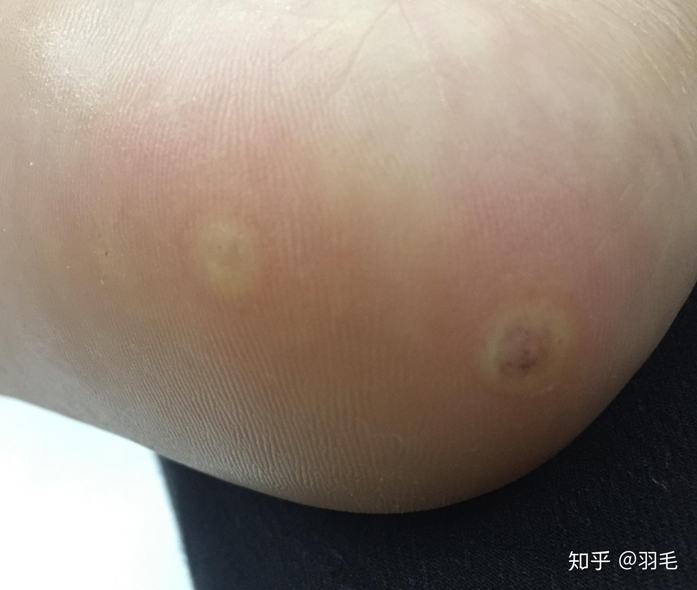 跖疣冷冻全过程