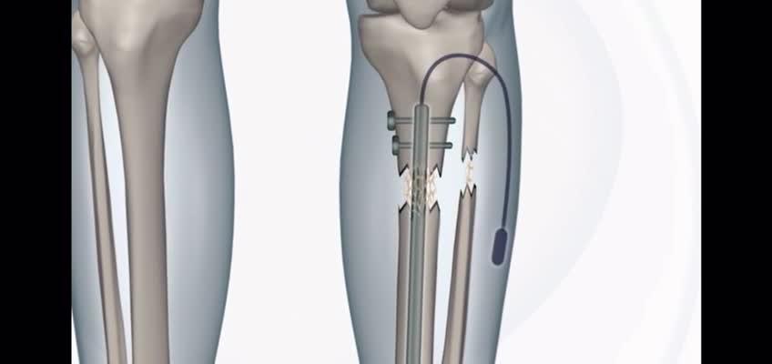 断骨增高有风险吗内置不会外置致残大概率