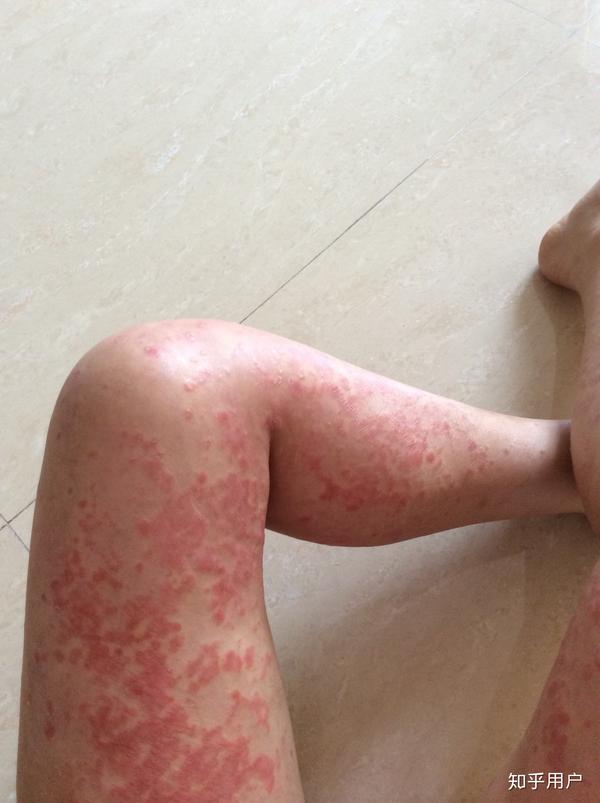 我一个女生得了银屑病,身上有遗留的色素沉淀,这个病仿佛一座大山压着