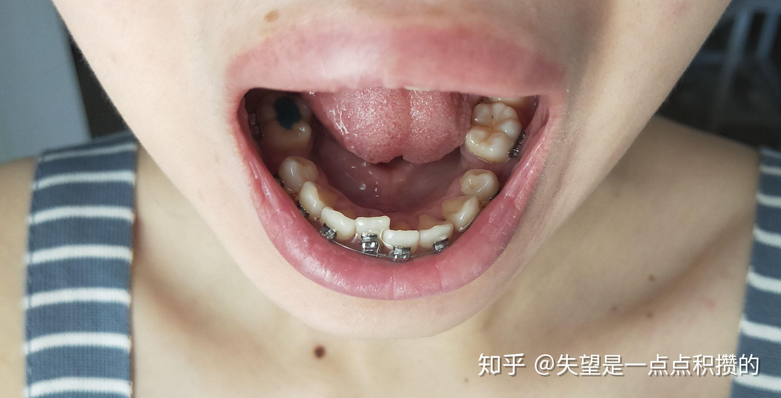 龅牙矫正有年龄限制吗？_深圳爱康健口腔医院(官网)