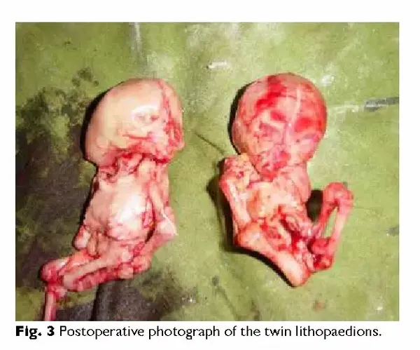 七个月打掉的胎儿图片图片