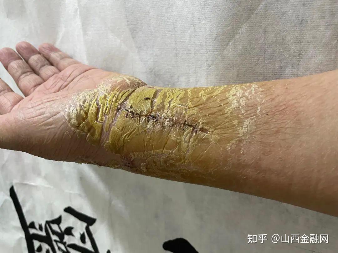 临汾女子被电动车刮倒在地手腕骨折肇事者不闻不问