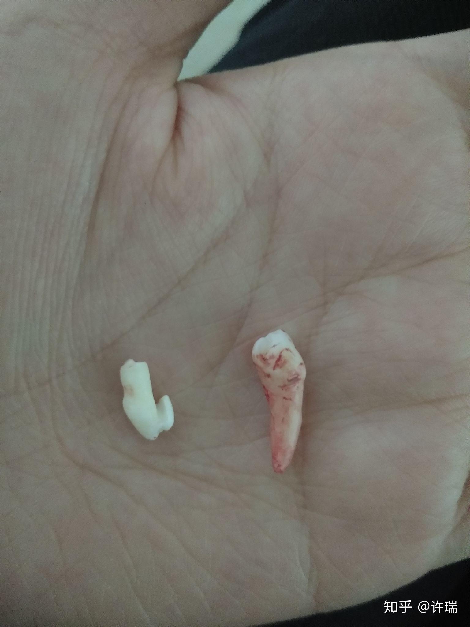 后拔牙(原本以为只有一颗多生牙,没想到牙的后侧颚还有一颗倒着的牙