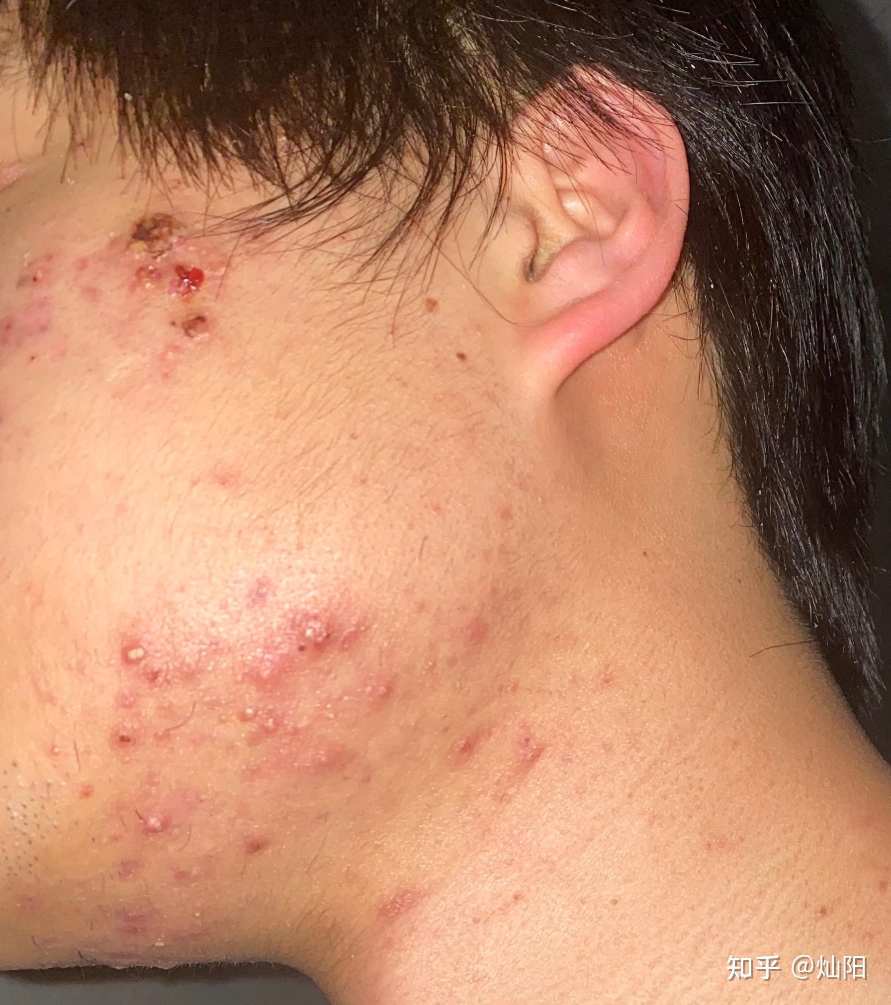 分别是异维a酸软胶囊(泰尔丝),克林霉素甲硝唑搽剂,过氧苯甲酰凝胶