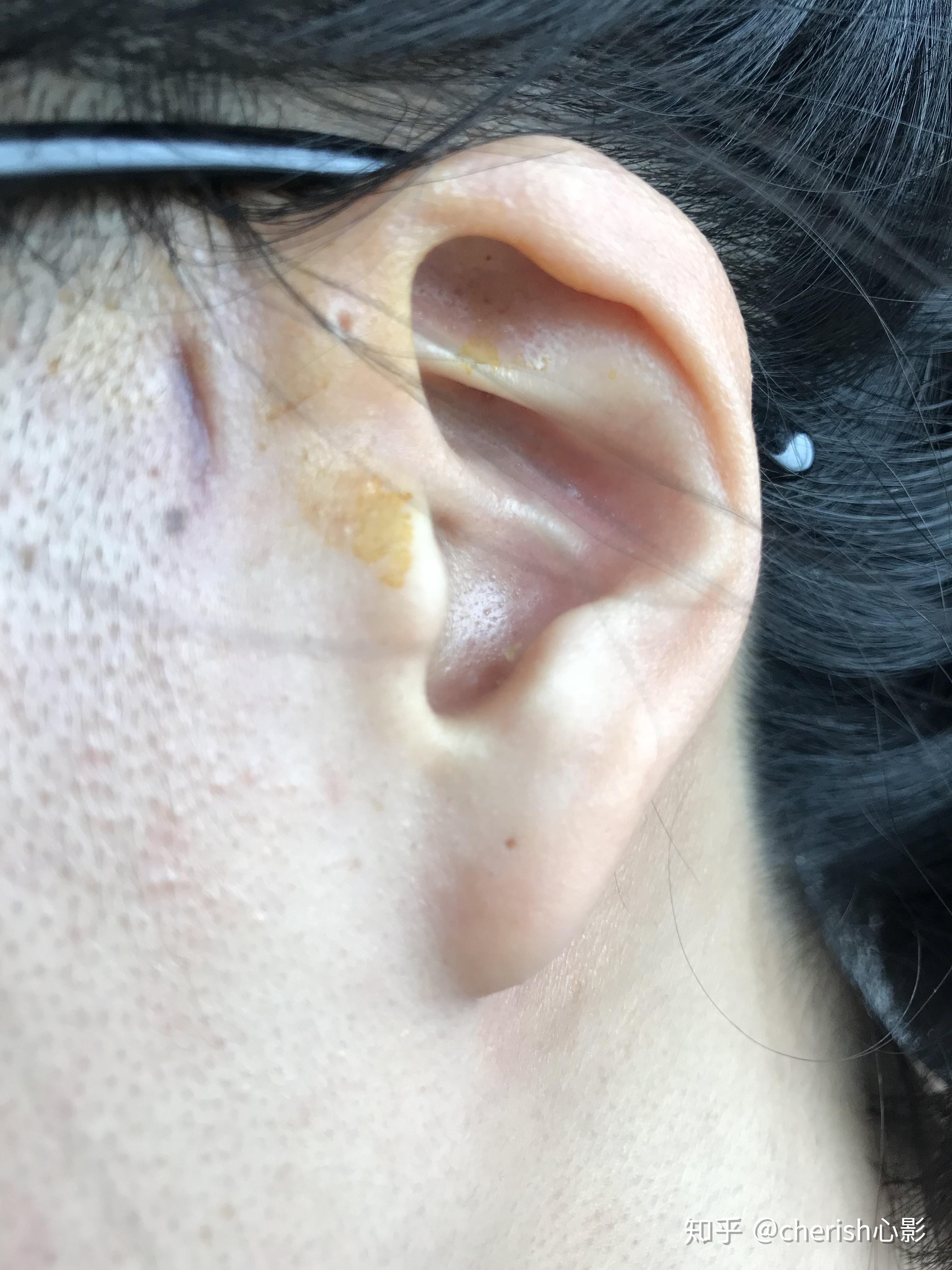 耳前瘘管引流 手术