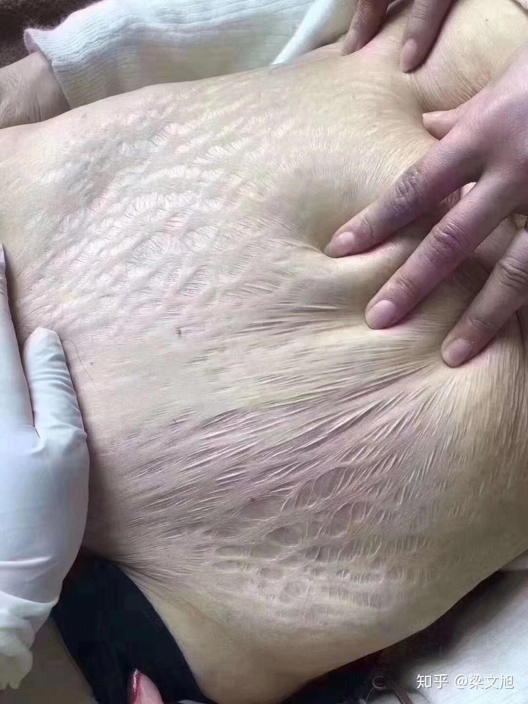 对于妊娠纹你的痛苦有几分