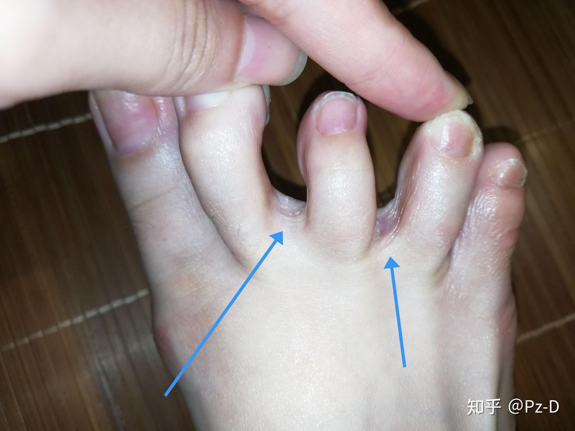 在学校的日子里也买过足光散之类的东西来泡脚,除了把脚泡的脱了一层