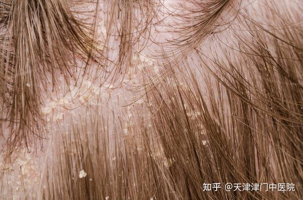 头痒、皮屑多,头皮银屑病还是头部溢脂性皮炎? - 知乎