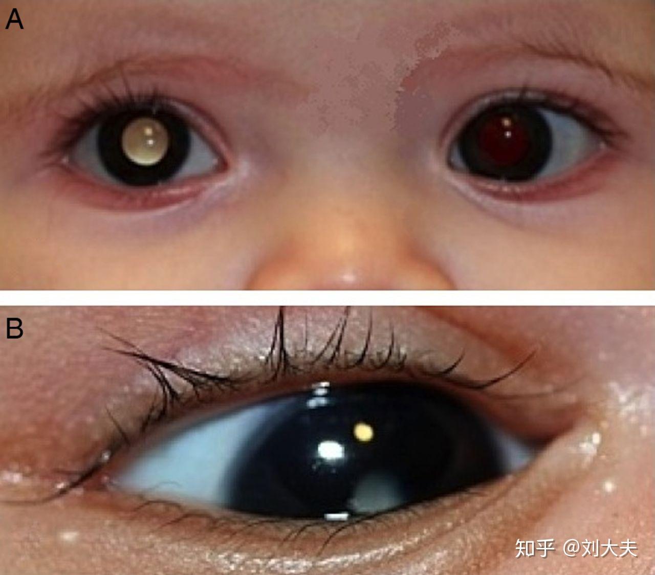 发生在婴儿身上的白内障,瞳孔内会出现白色或灰色的混浊,必须由眼科