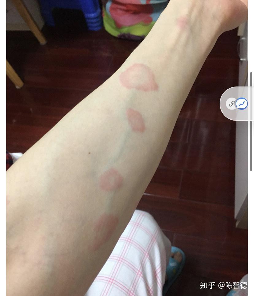 这是什么荨麻疹?反复发作,吃中西药都没有效果!求救! - 知乎