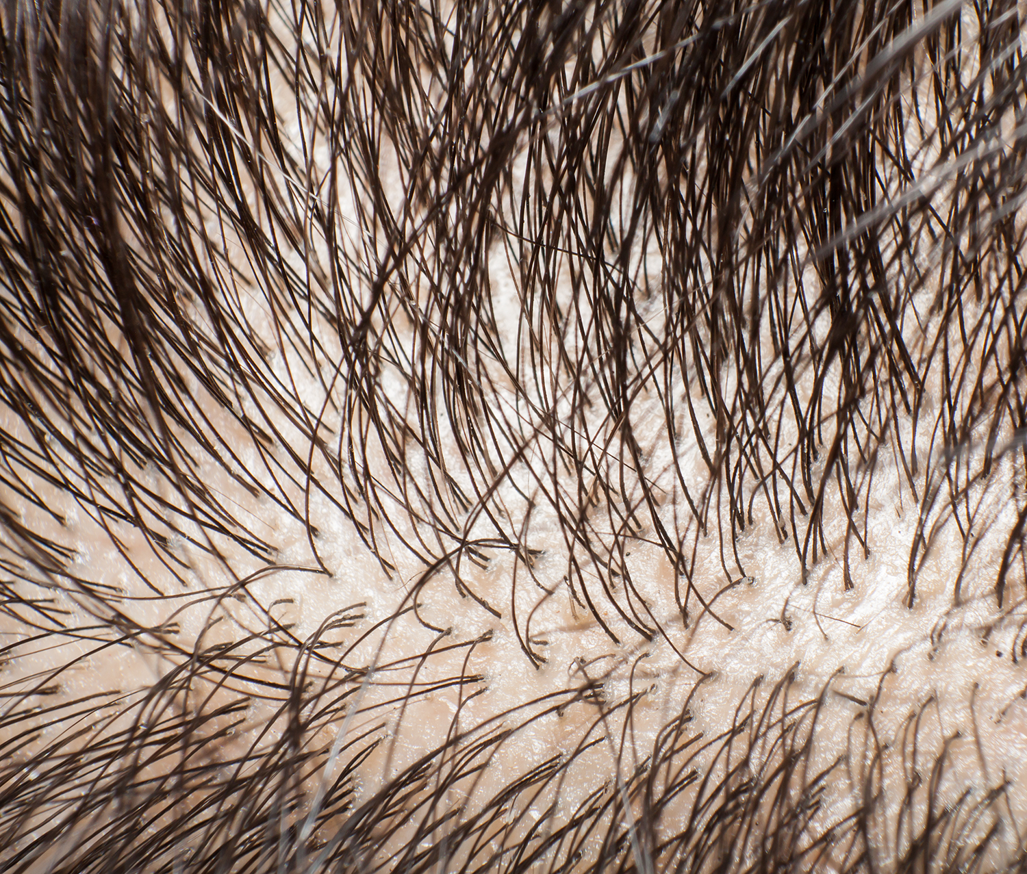 糠秕孢子菌毛囊炎（马拉色菌毛囊炎）个人治疗经历 - 知乎
