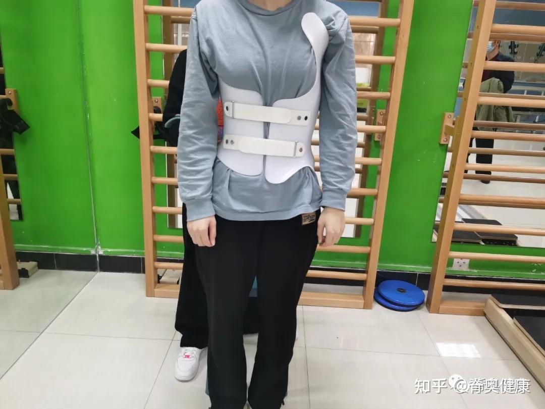 脊奥健康|少女脊柱侧弯案例展示--脊柱侧弯 扁平足