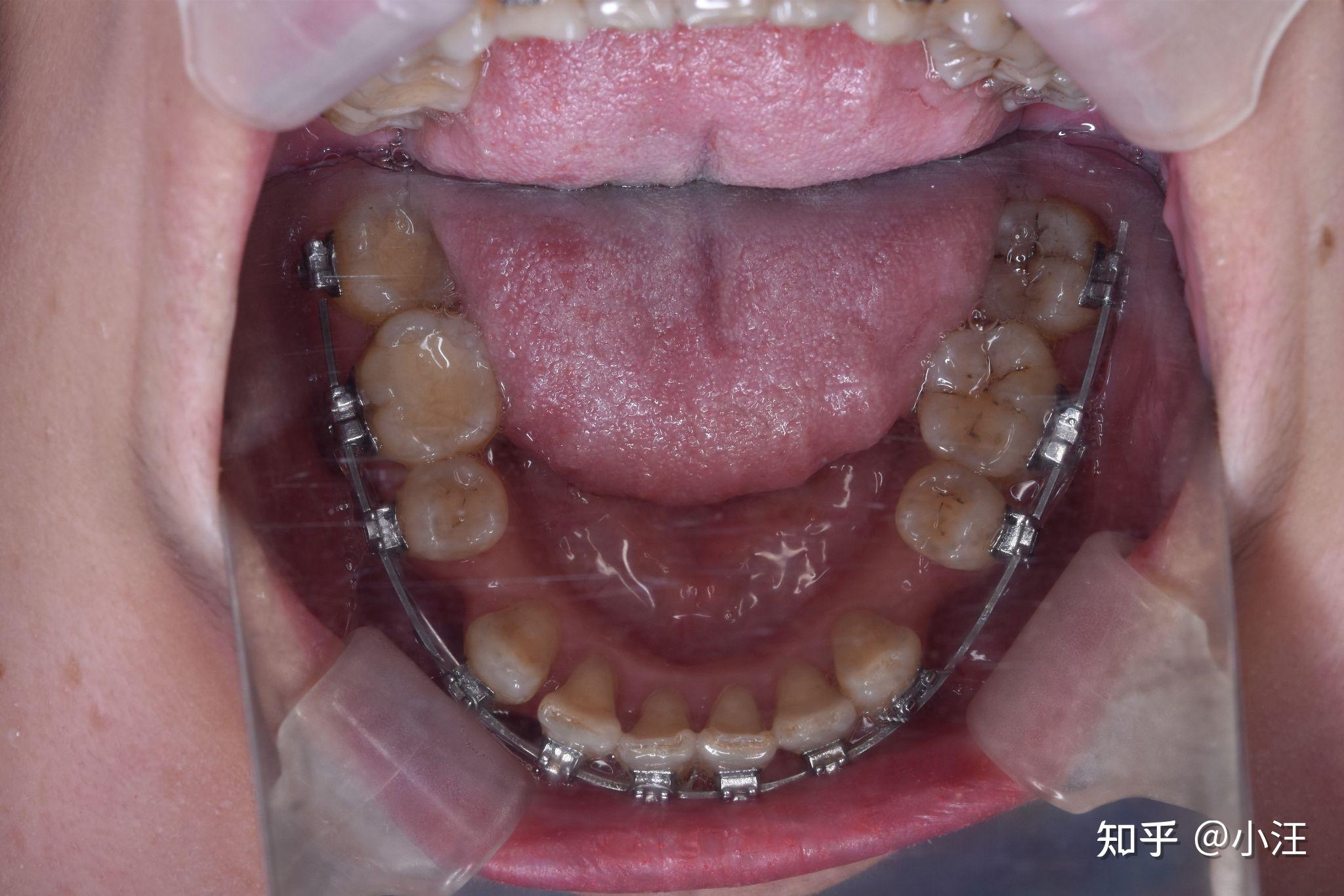 正畸失败该如何继续