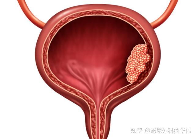 膀胱癌是怎么引起的图片