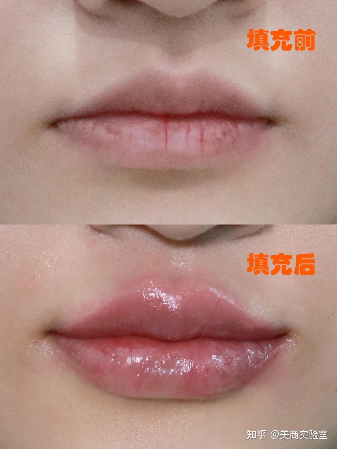 厚唇改薄有好的医院吗?做M唇价格多少?附:案例费用分享