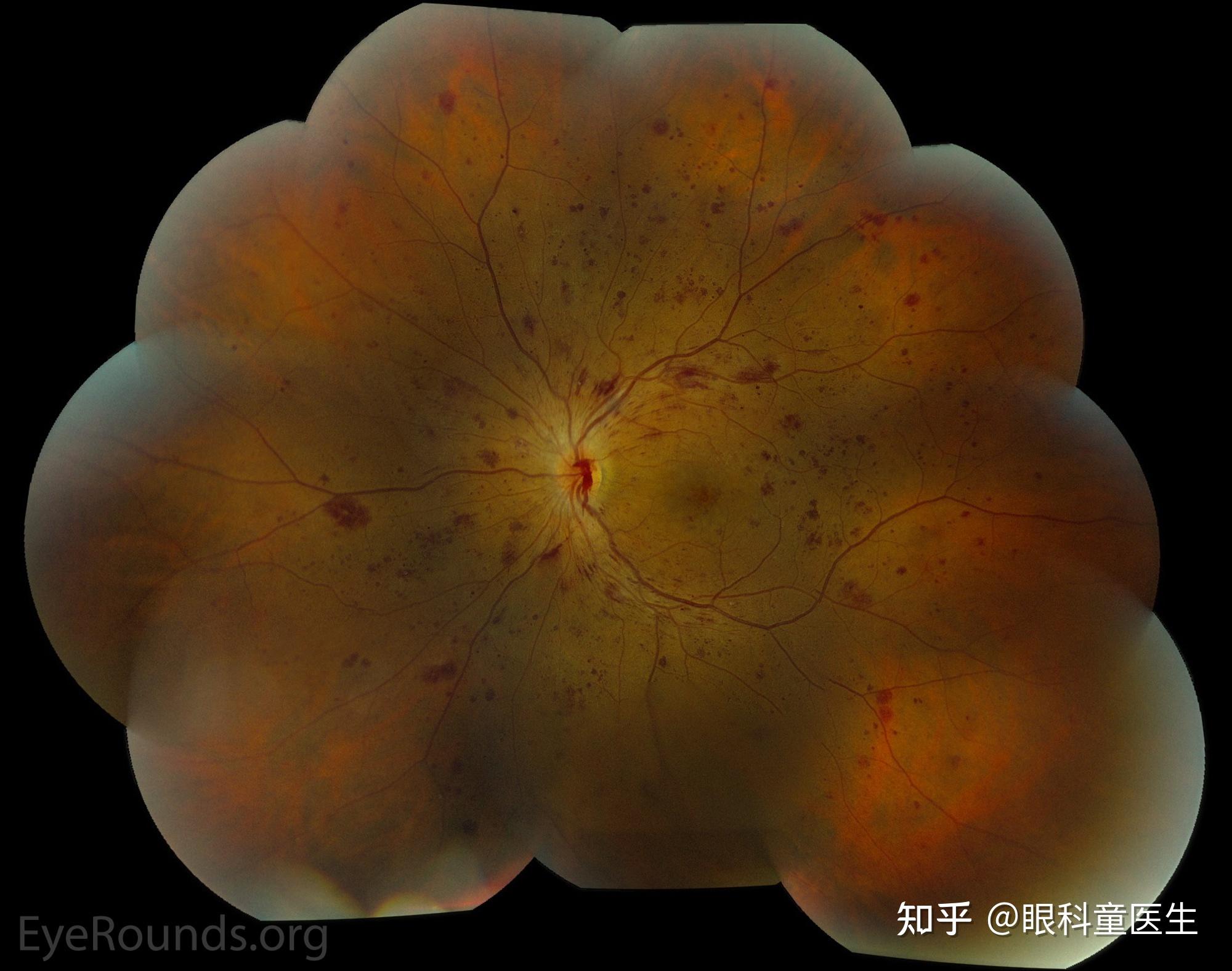 與外傷相關的視網膜病變5放射性視網膜病變