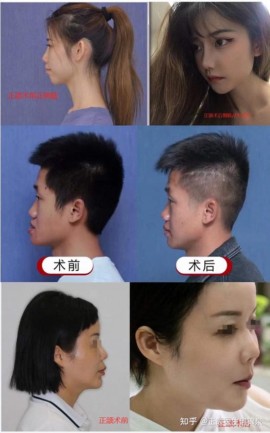 如何判断自己是否存在下巴 …