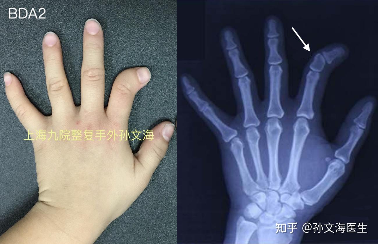 短指症の見通し