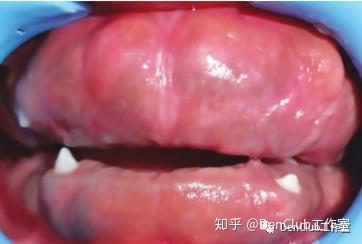 你可能不知道的口腔遗传性疾病今日分享の遗传性牙龈纤维瘤病