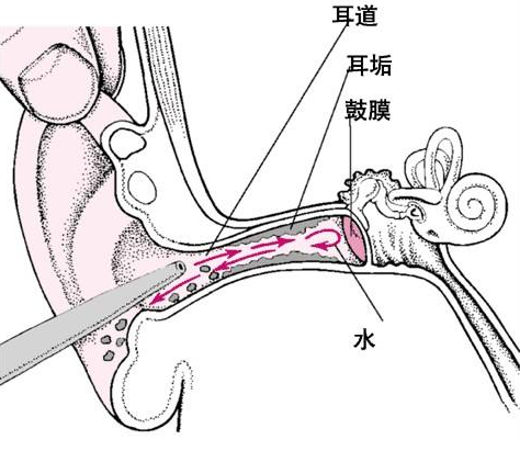 外耳道炎的治疗及预防 知乎