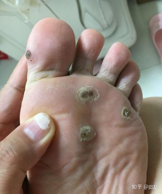 说下跖疣要怎么解决