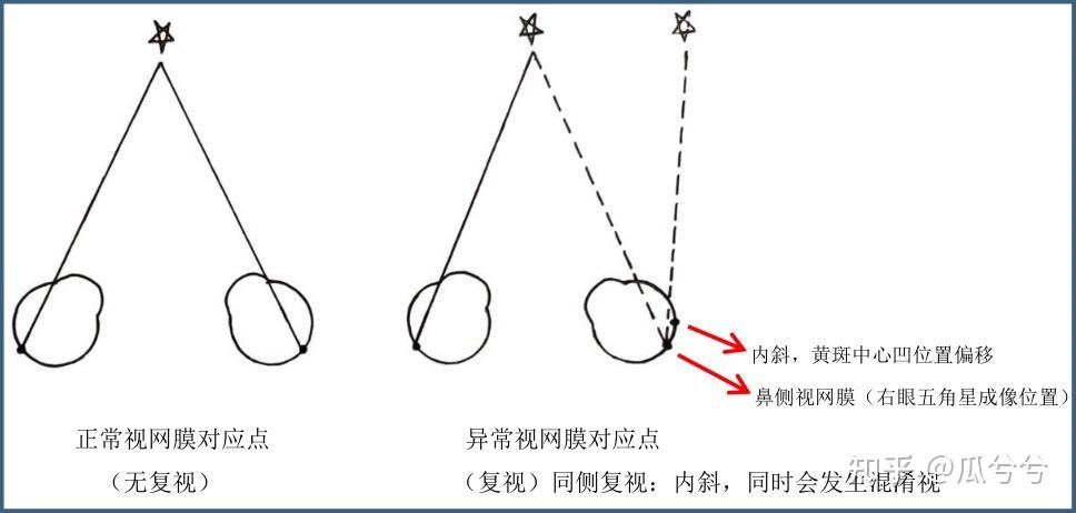 复视看东西的样子图片图片