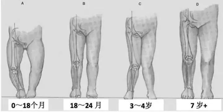 o型腿x型腿的寶寶該如何矯正呢