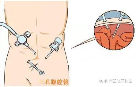 什麼是單孔腹腔鏡腹股溝疝修補術有何優勢