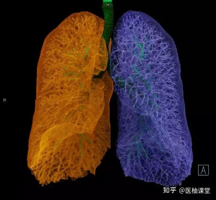 非常详细的肺部影像解剖 - 知乎