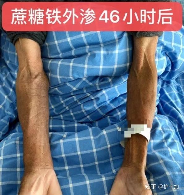 蔗糖铁外渗竟有如此严重下一步该怎么办