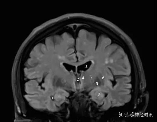 史上最全脑室解剖图谱快收藏了吧 - 知乎