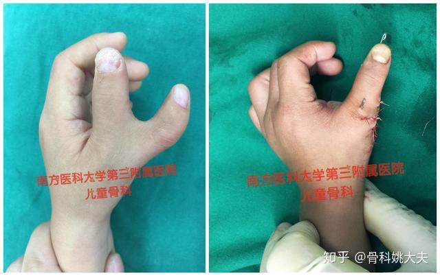 默认最新啊啊啊为啥我爸妈都是正常的,我是六指.