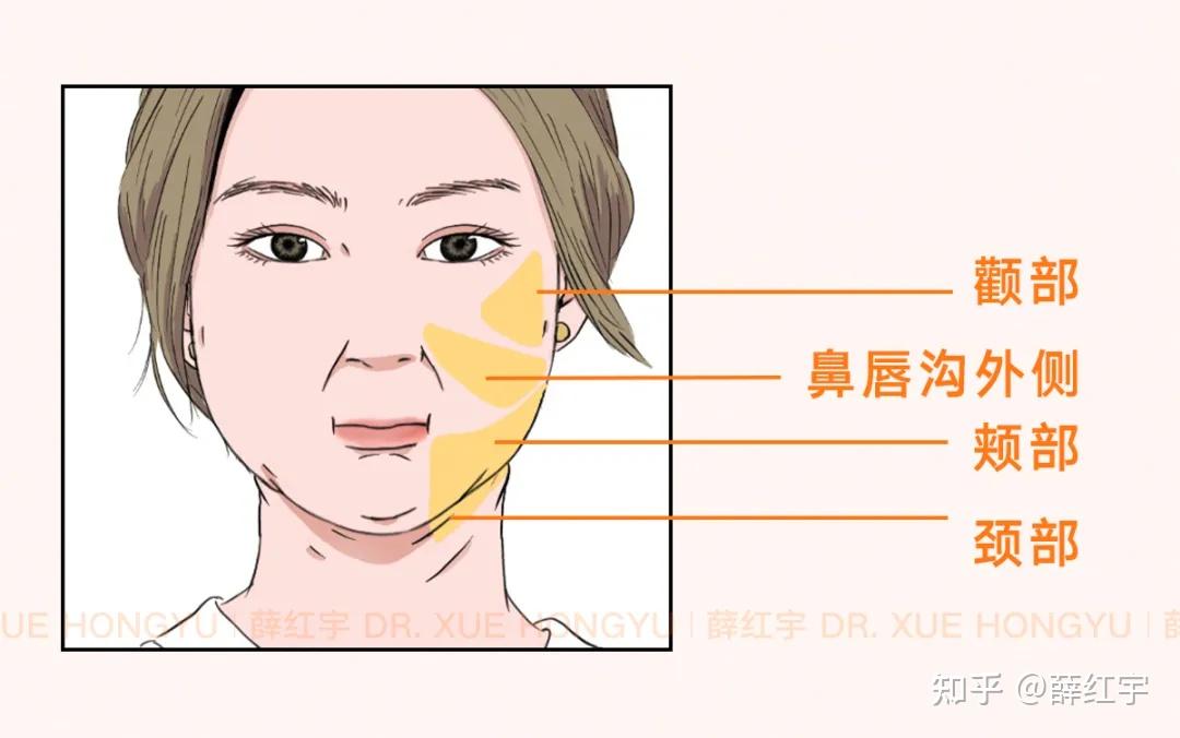 吸脂部位一般为颧部,鼻唇沟外侧,颊部,颈部.