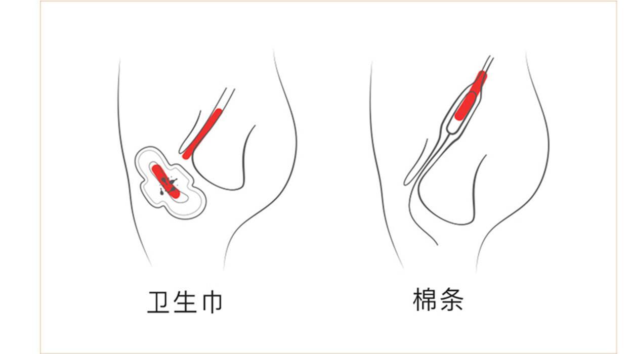 女性卫生棉条用不好容易患妇科病?