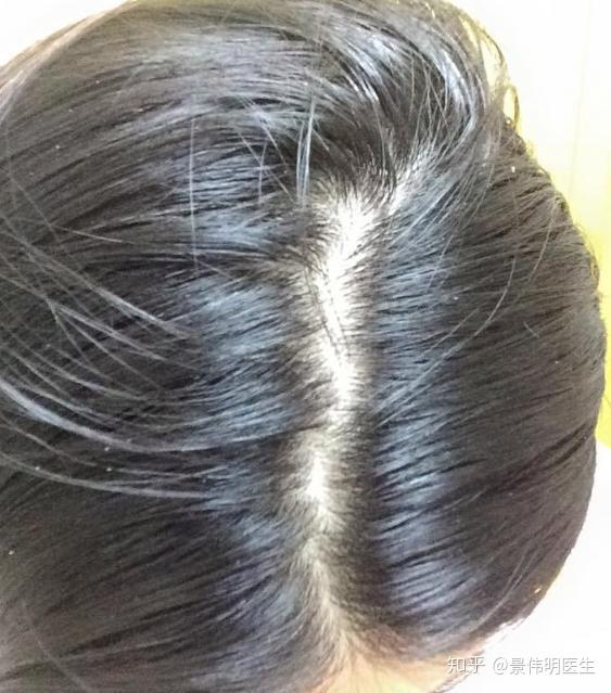 发缝越来越宽,中分变成四六分,发缝就不会变宽了吗? - 知乎