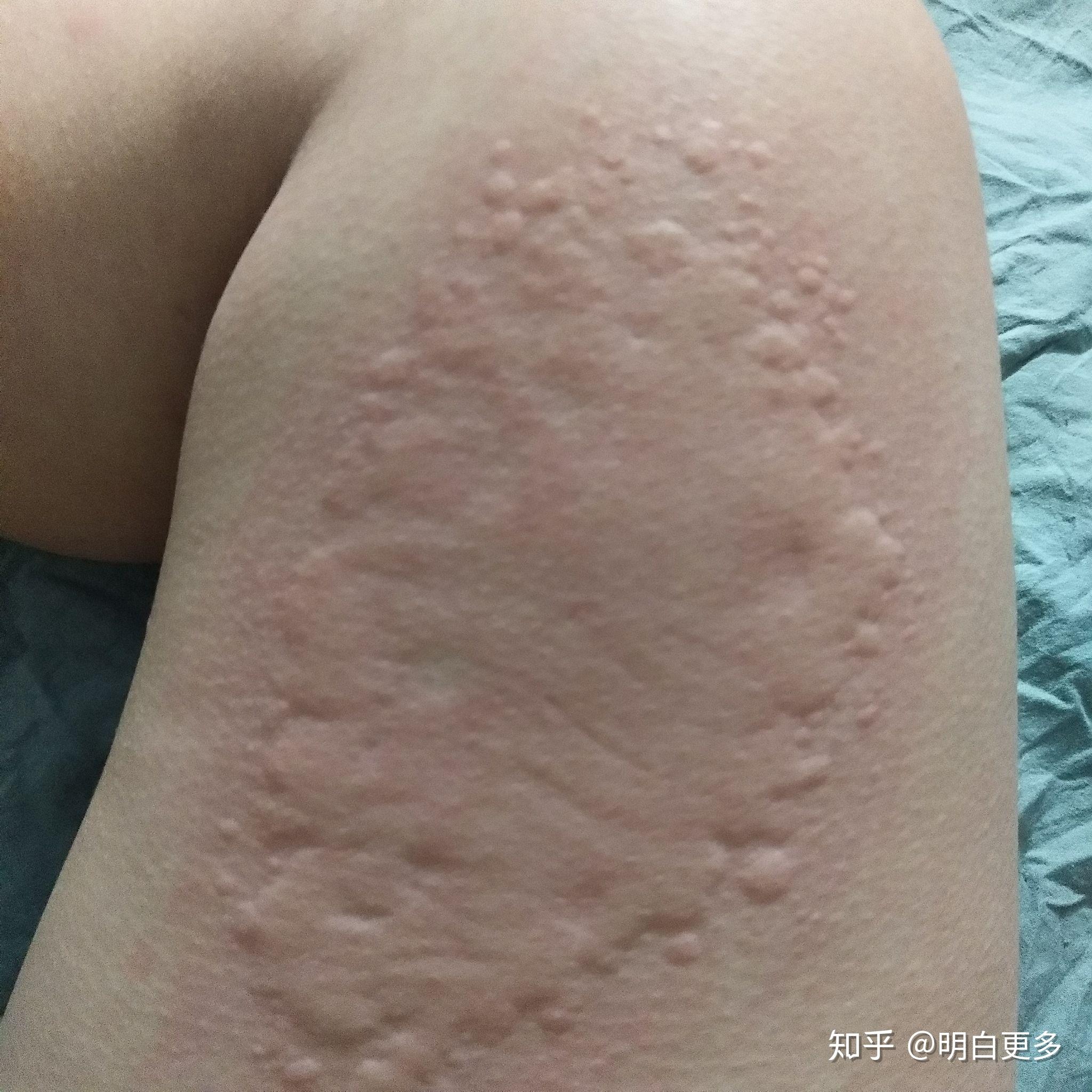 慢性荨麻疹初期图片图片