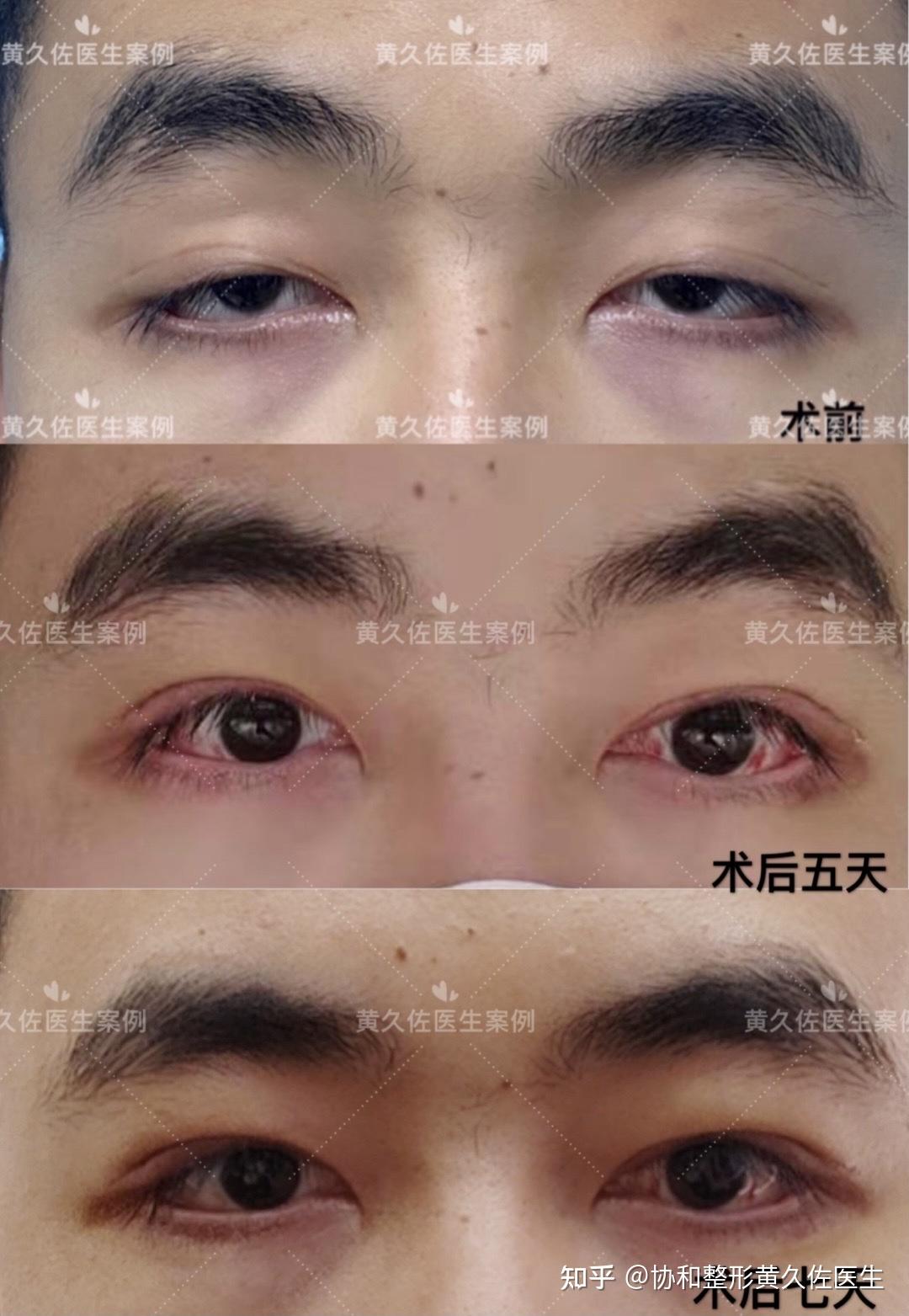 cfs悬吊术矫正重度上睑下垂案例分析 - 知乎