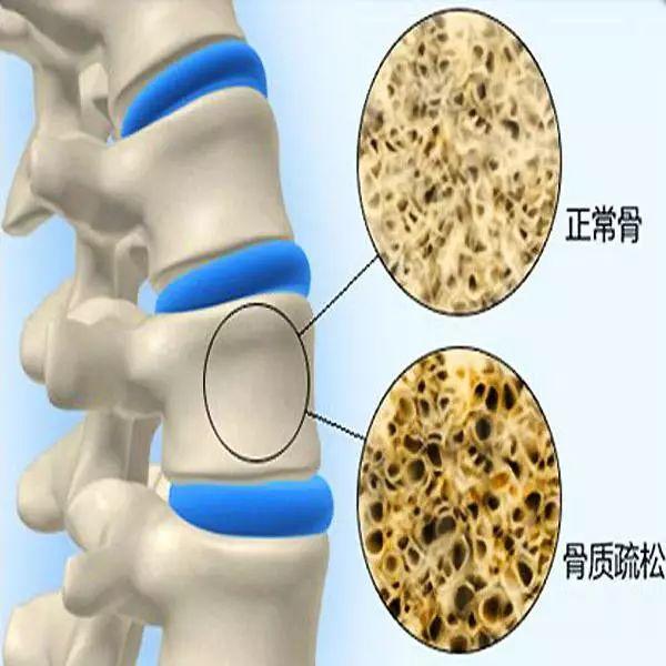 骨质疏松须防治