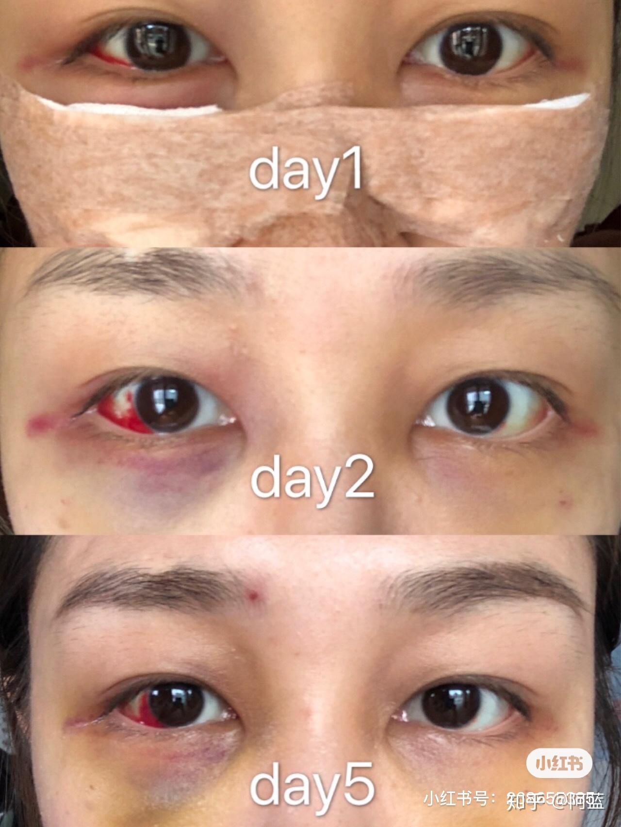 内切眼袋 眶隔释放 - 知乎