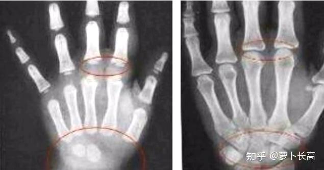 这张骨的图片,左边是还没有闭合,就是存在一条小缝,然后右边的话是