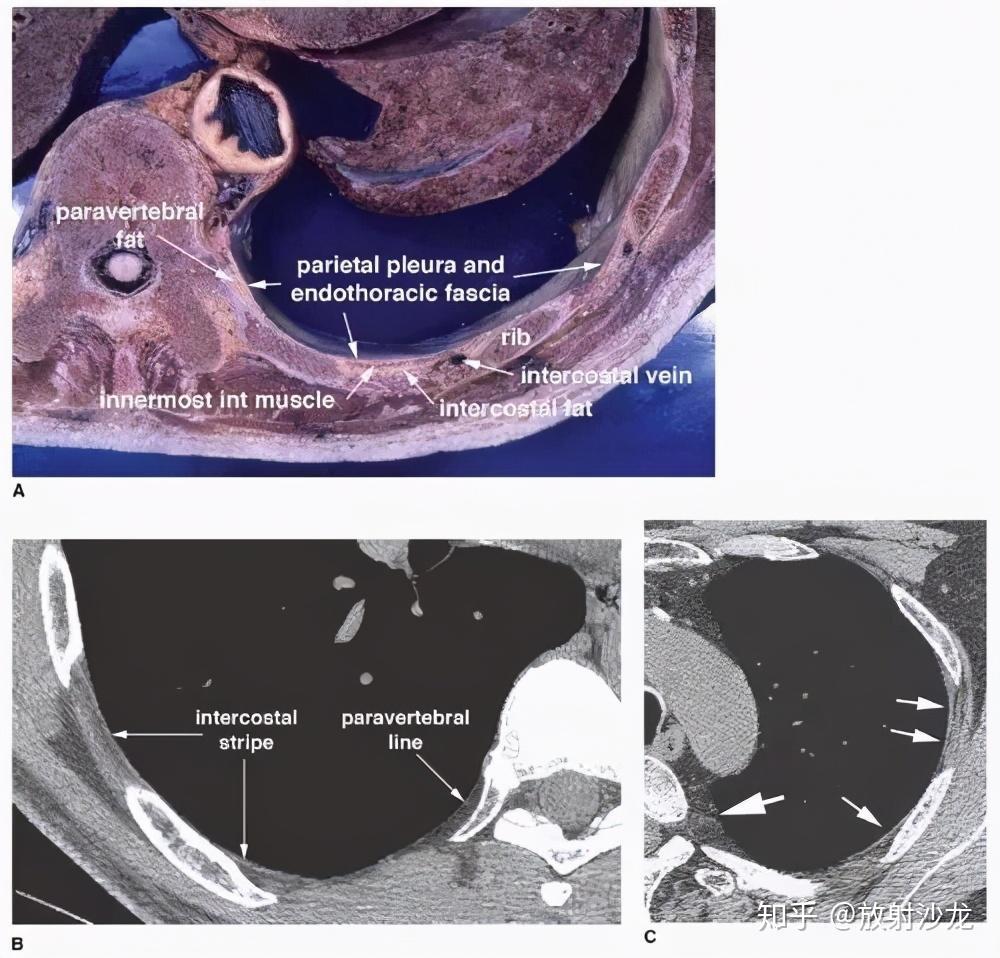 手把手教你胸部ct定位 - 知乎