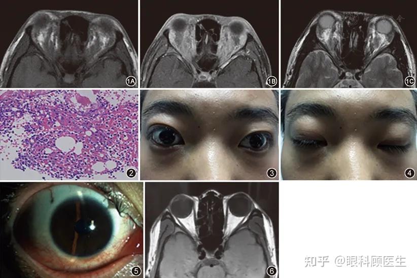 白血病眼球突出图片图片